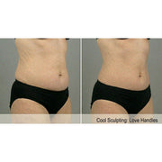 CryoShape: Cryolipolysis Machine