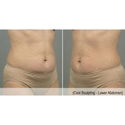 CryoShape: Cryolipolysis Machine