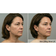 Contour X: HIFU Ultrasound