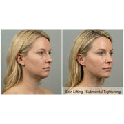 Contour X: HIFU Ultrasound