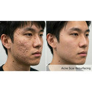 Resurf CO2: CO2 Fractional Laser