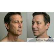 Resurf CO2: CO2 Fractional Laser
