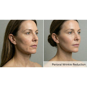 Resurf CO2: CO2 Fractional Laser