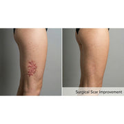 Resurf CO2: CO2 Fractional Laser