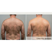 DermaLux: 808nm Diode Laser