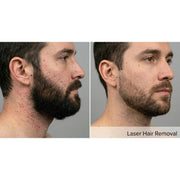 DermaLux: 808nm Diode Laser