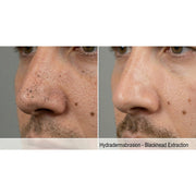 HydraGlow: Hydradermabrasion
