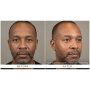 HydraGlow: Hydradermabrasion