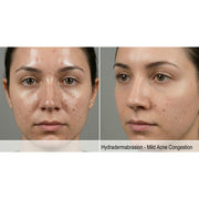 HydraGlow: Hydradermabrasion