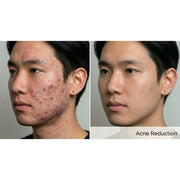 Dualis X: ND:YAG Laser
