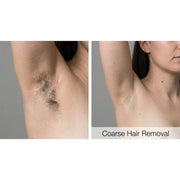 Dualis X: ND:YAG Laser