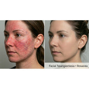 Dualis X: ND:YAG Laser