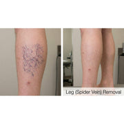 Dualis X: ND:YAG Laser