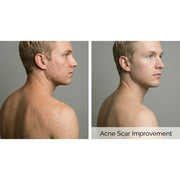 PicoPulse: Picosecond Laser