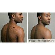 PicoPulse: Picosecond Laser