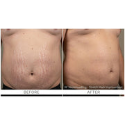 FirmX RF: RF Microneedling