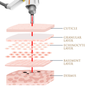 Skin Monarch Picosecond Tattoo Removal Laser 1500W