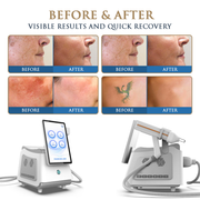 Skin Monarch Picosecond Tattoo Removal Laser 1500W